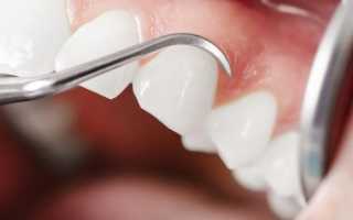 Воспаление десны около зуба лечение антибиотиками
