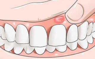 Что такое надкостница зуба
