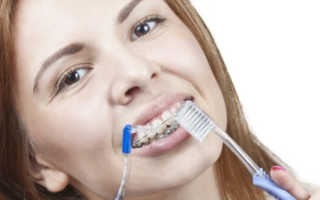 Как ухаживать за брекетами и зубами