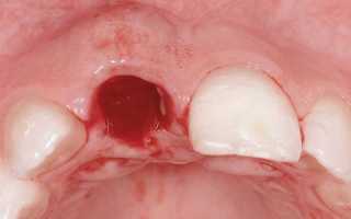 Чем снять воспаление десны после удаления зуба