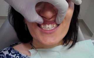 Скученность зубов лечение без брекетов
