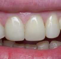 Реставрация зубов до и после
