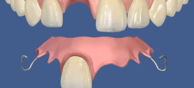 Какие вставные зубы лучше вставлять
