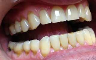 Клиновидный дефект зубов лечение в домашних условиях