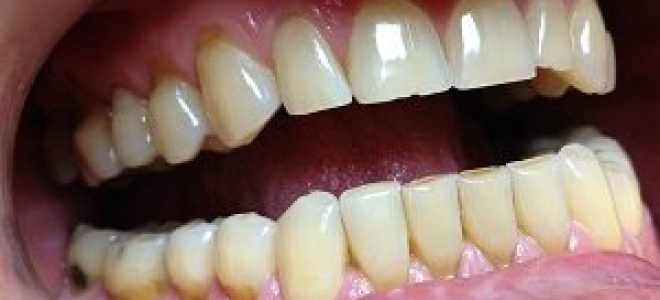 Клиновидный дефект зубов лечение в домашних условиях