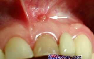 Можно ли вылечить свищ без удаления зуба