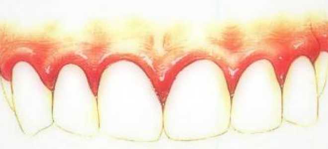 Воспалилась десна и болит зуб