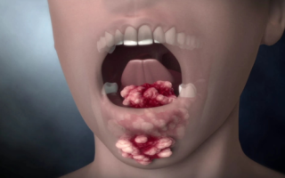 Как выглядит рак полости рта
