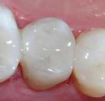 Болит зуб при накусывании после лечения