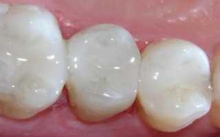 Болит зуб при накусывании после лечения