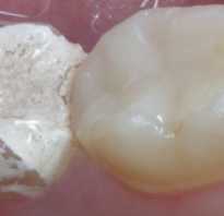 Как выглядит мышьяк в зубе