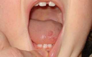 Стоматит на языке лечение у детей