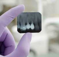 Что показывает рентген зуба