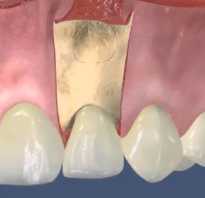 Резекция верхушки корня зуба после операции