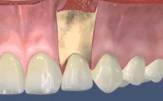 Резекция верхушки корня зуба после операции