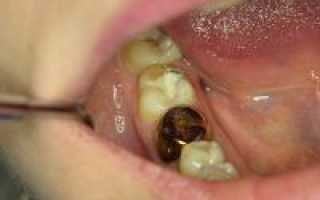 Почему пломбированный зуб болит