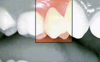 Протезирование одного зуба без обточки соседних зубов