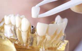 Как ставят зубные коронки