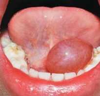 Кровяная шишка под языком