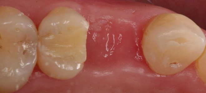 Белый налет на лунке после удаления зуба