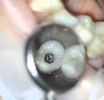 Титановые штифты в стоматологии