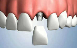 Как проходит имплантация зубов