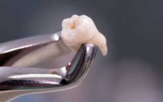 Сколько дней болит десна после удаления зуба