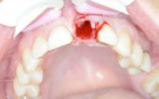 Чем остановить кровь после удаления зуба
