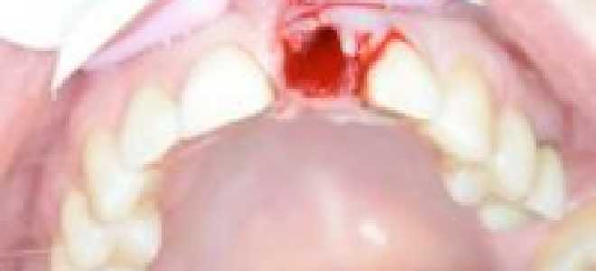 Если не останавливается кровь после удаления зуба
