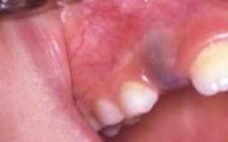 Почему образуется киста на корне зуба