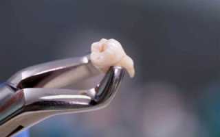 Удаление верхнего зуба