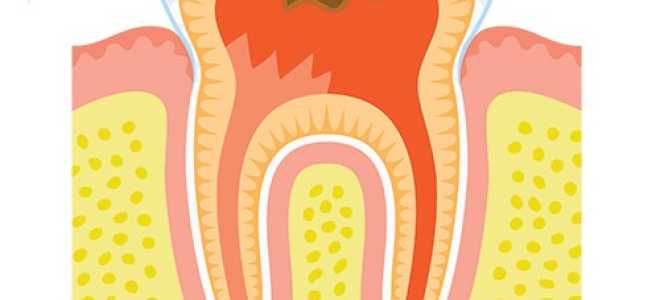 Удалить кисту зуба