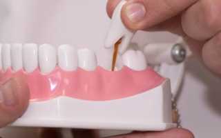 Несъемное протезирование зубов виды