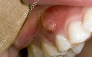 Что такое зубной свищ