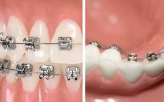 Зубы до и после брекетов