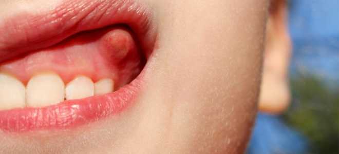 Удаление гнойного зуба