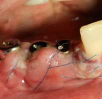 Состояние после имплантации зубов