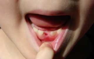 Какие зубы выпадают у ребенка
