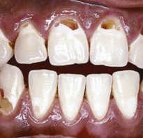 Дырки в зубах около десен