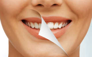 Отбеливание зубов плюсы и минусы