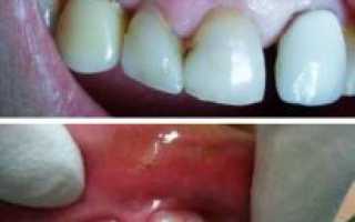 Киста зуба под коронкой лечение