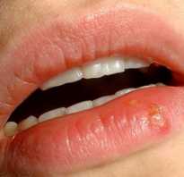 Как вылечить болячку на губе