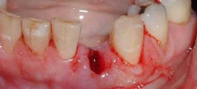 Сколько должна идти кровь после удаления зуба