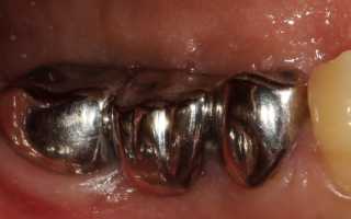 Виды коронок на жевательные зубы