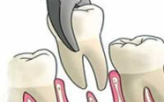 Имплантация сразу после удаления зуба