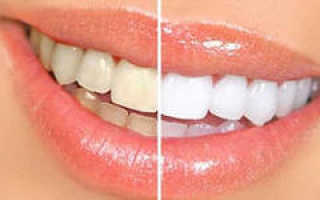 Что такое люминиры в стоматологии
