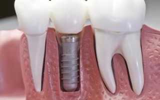 Зубные импланты за и против