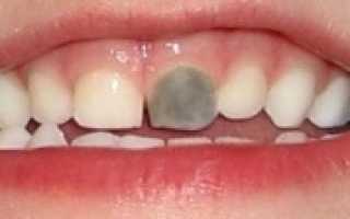 Почему у детей чернеют молочные зубы