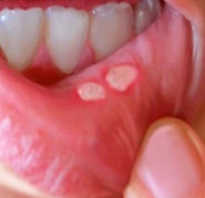 Чем лечить стоматит на губе