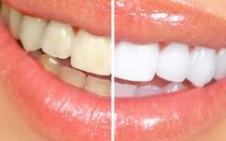 Композитное отбеливание зубов